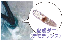 皮膚ダニ 皮膚ダニ